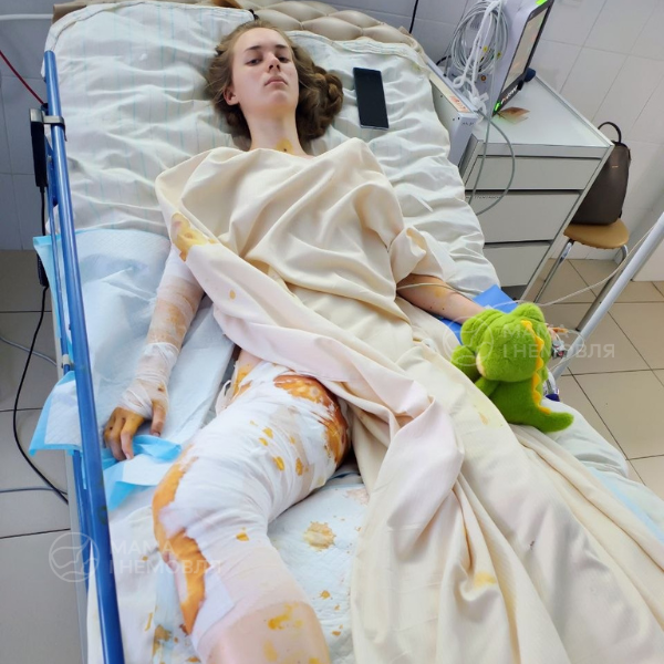 Допоможімо Оленці врятувати ноги після удару по Сумах
